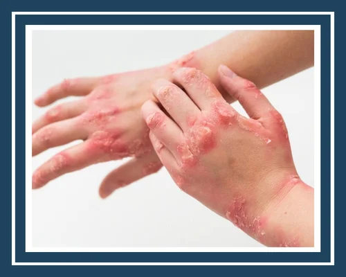 Allergy Control Treatment