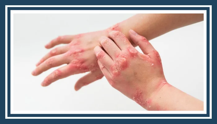 Allergy Control Treatment